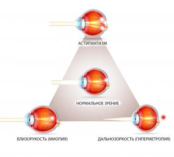 зрение при астигматизме, близорукости, дальнозоркости
