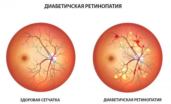 Диабетическая ретинопатия