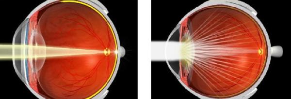 схема глаза при катаракте