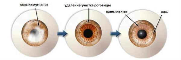 кератопластика операция