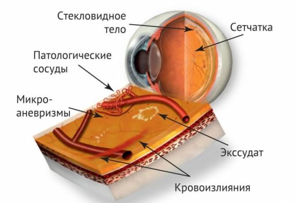 Диабетическая ретинопатия