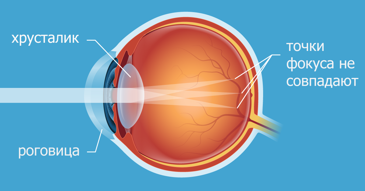 Фокусировка глаза человека. Астигматизм роговицы глаза. Оптическая система глаза. Оптическая система глаза человека. Формирование изображения на сетчатке глаза.
